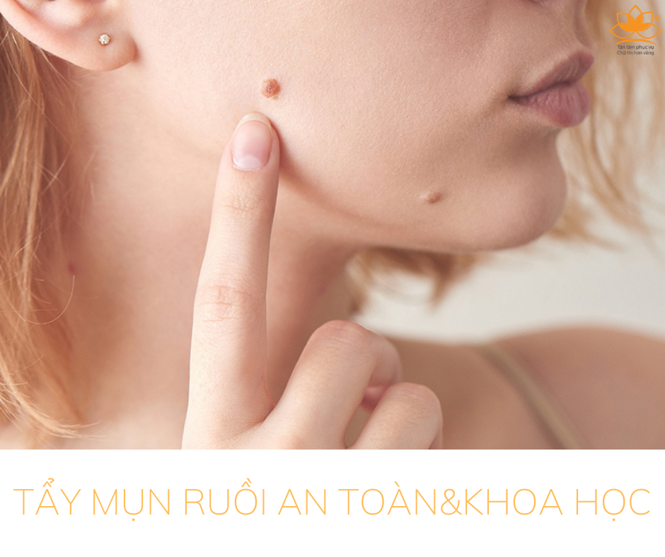 TẨY NỐT RUỒI AN TOÀN&KHOA HỌC